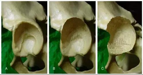 髋臼骨质破坏一般怎么治,髋臼骨缺损