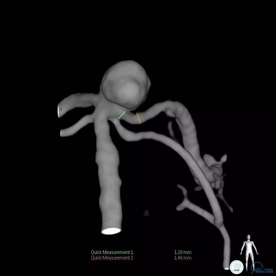 颈动脉瘤介入栓塞康复后可活多久,动脉瘤微创栓塞术全过程