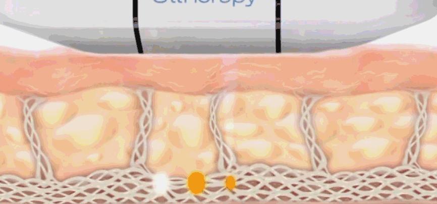 超声刀怎么样啊 (超声刀分享)