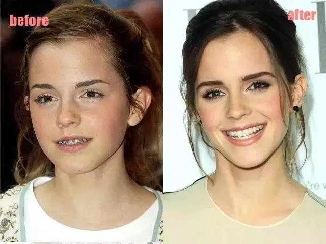 整牙=整容?看杨幂、刘涛、高圆圆为你亲身示范!