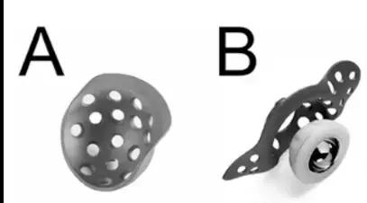 髋臼底严重骨缺损怎么翻修,髋臼骨缺损2厘米能愈合吗