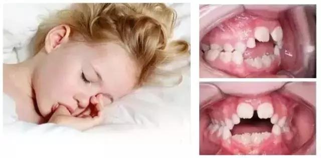 孩子口呼吸有什么危害,孩子口呼吸对智力有影响吗