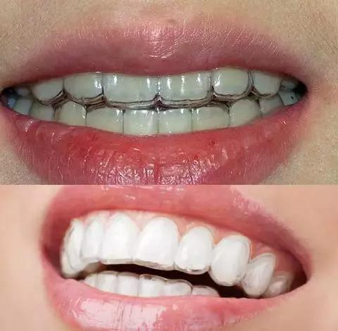 整牙=整容?看杨幂、刘涛、高圆圆为你亲身示范!