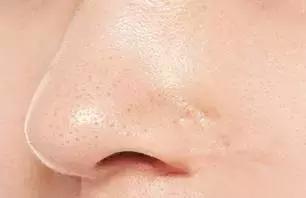 身体毛孔粗大并且里面是黑的,毛孔粗大变成了一个洞