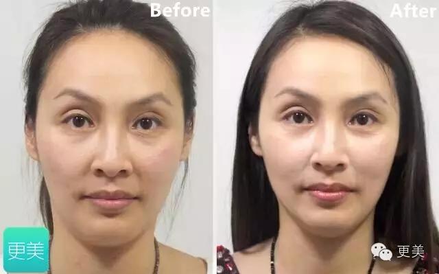 青春定格？4D埋线？音波拉皮？别晕，面部提升就那老三样