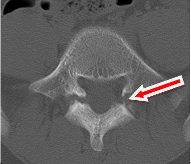 腰椎峡部裂最佳锻炼方式,腰椎峡部裂的最好治疗方法