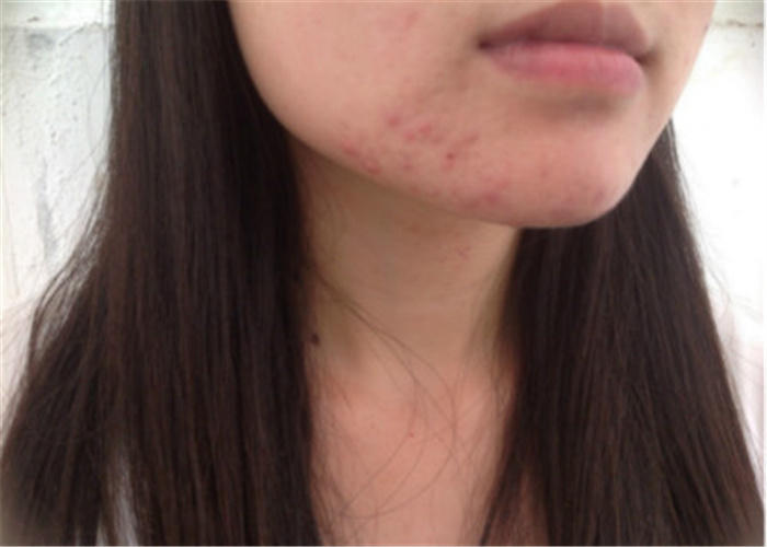 下巴疯狂起脓包痘痘怎么办,下巴狂长痘