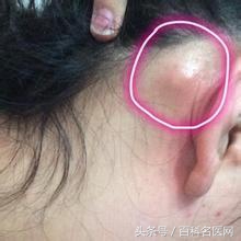 恶性肿瘤身上有很多包是咋回事,身上长个包是恶性的是什么意思