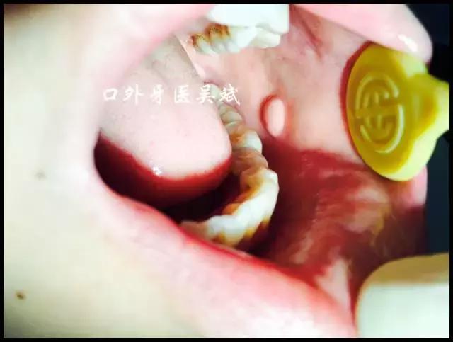 嘴里长疱疹怎么办,嘴里起脓疱怎么办