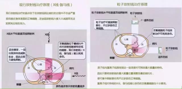 中国的质子中心有几家,全国有几所质子医院哪所最好