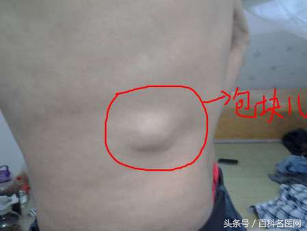 恶性肿瘤身上有很多包是咋回事,身上长个包是恶性的是什么意思