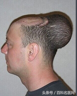 恶性肿瘤身上有很多包是咋回事,恶性肿瘤转移身上很多包块