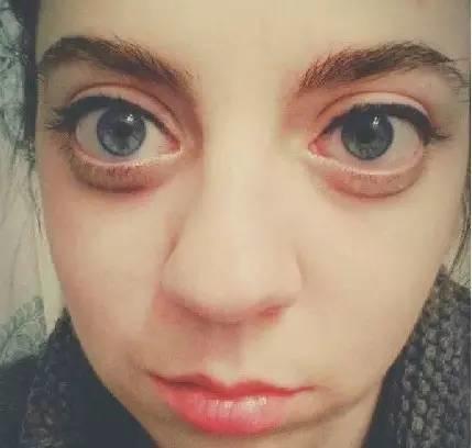 眼袋和卧蚕的区别看完你就知,卧蚕和眼袋的区别你知道吗