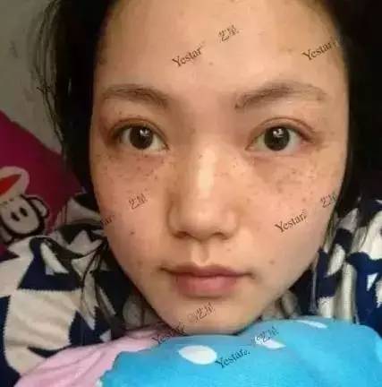 激光祛斑后还会反弹吗,激光祛斑后会不会反弹