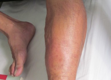 小腿胀痛怀疑是血栓怎么防治,站久后小腿胀是不是有血栓