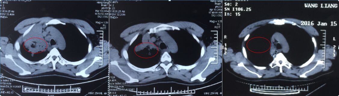 a45靶向疗法,a45靶向治疗哪家医院有