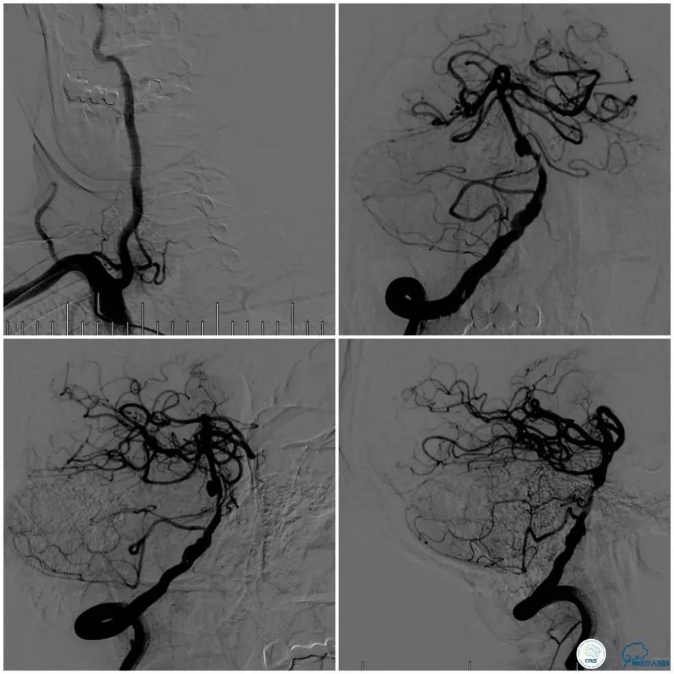 天坛周记|基底动脉狭窄合并动脉瘤血管内介入治疗一例