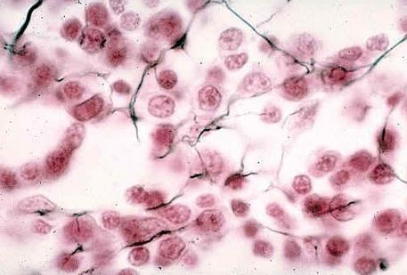 结缔组织病预兆,结缔组织病50岁死亡率高吗