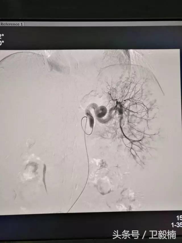 微创介入科一卫毅楠,什么是心血管介入治疗