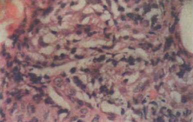 红色斑丘疹是湿疹吗,红斑丘疹误诊湿疹