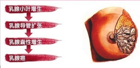 乳腺增生民间小偏方,乳腺纤维瘤食疗小偏方