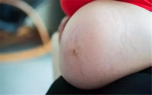 预防妊娠纹的10个方法,妊娠纹预防最好的办法