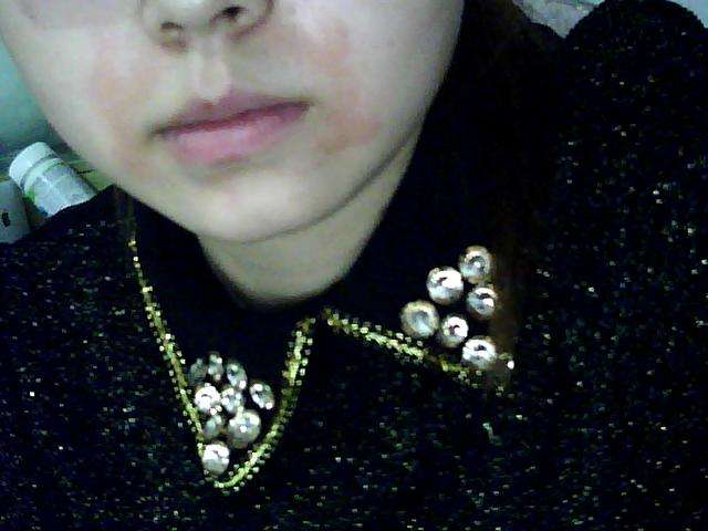 嘴巴周围有红斑点是什么原因,嘴巴周围长红斑溃疡