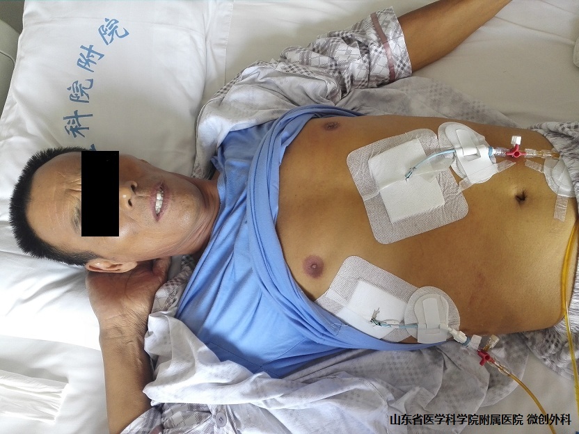 “小引流大作用”救命的胆道外引流管治疗晚期肿瘤性黄疸