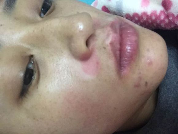 白斑光照,白斑光照后图片