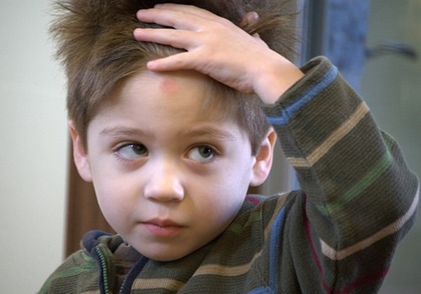 婴儿撞到头后什么症状要注意,孕妈撞到头起包怎么处理