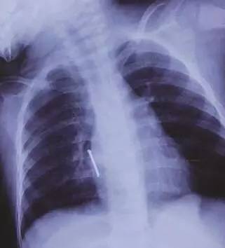 医生在儿童耳朵里取出异物,医生给小孩耳朵取异物视频