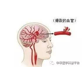 牙龈自发出血是什么病的前兆,自发出血是什么意思