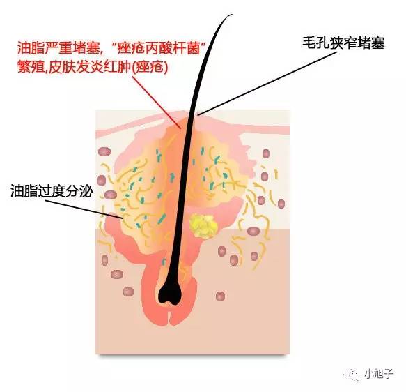 闭口痘痘的痘印可以消除吗,痘痘痘印闭口怎么彻底去除