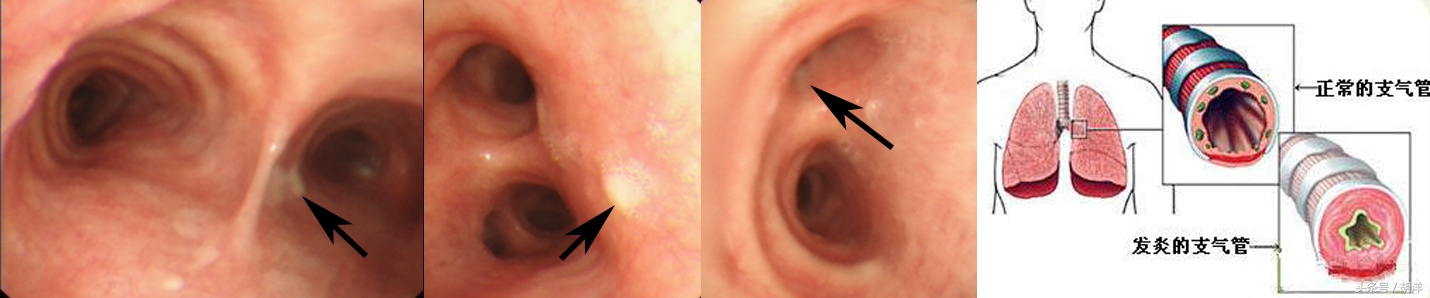 咳嗽、气管炎，此方用一次，明天就能好，为了健康，还是备着吧！
