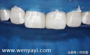 门牙有缝是什么说法,门牙有缝怎么办如何补救