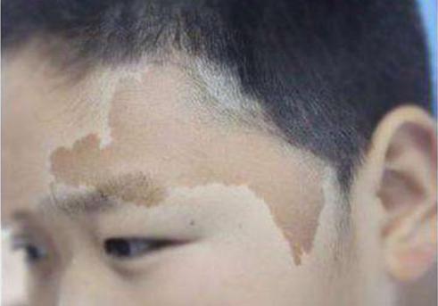 胎记去除特效药,胎记偏方