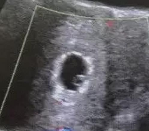 多久才可以判断胎停,多久以后就不用担心胎停