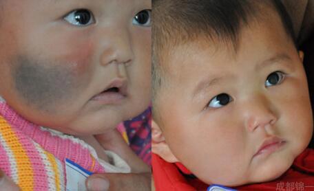 孩子有胎记如何避免孩子自卑,宝宝长胎记怎样避免心理健康