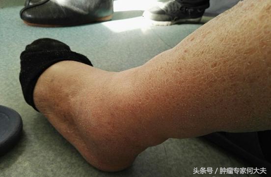 前列腺癌晚期贫血腿肿怎么办,前列腺癌晚期一侧腿肿怎么办