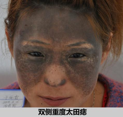 为什么胎记除不了根,为什么胎记不能被别人看见