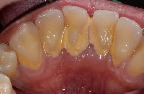 牙龈出血口臭有什么方法治疗,牙龈出血口臭快速治疗方法