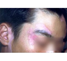 药离子和308治疗白癜风效果怎么样,308激光治疗白癜风医保报销吗