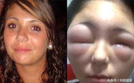 女性染发剂过敏视频,染发剂过敏眼部红肿
