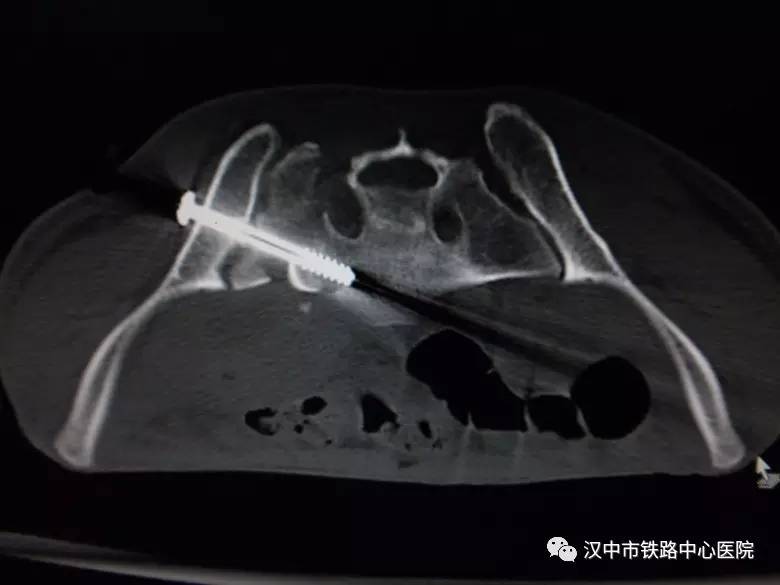 骨盆髋臼骨折内固定手术,骨盆骨折空心螺钉固定器械