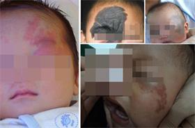 激光治疗胎记彻底吗,激光治疗胎记有副作用吗