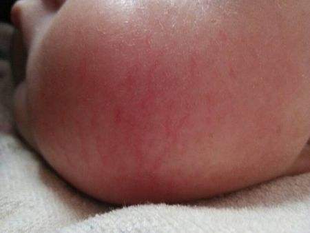 孩子脸上有像蜘蛛红色血丝,小孩脸上红色血丝怎么回事