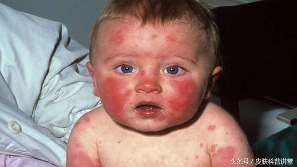 幼儿急疹的斑丘疹多久消失,幼儿急疹是否有痒的案例