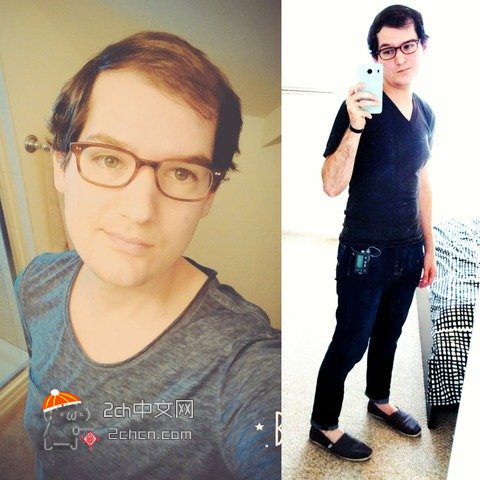 秃头大叔服用雌性激素,秃头男吃雌激素一年