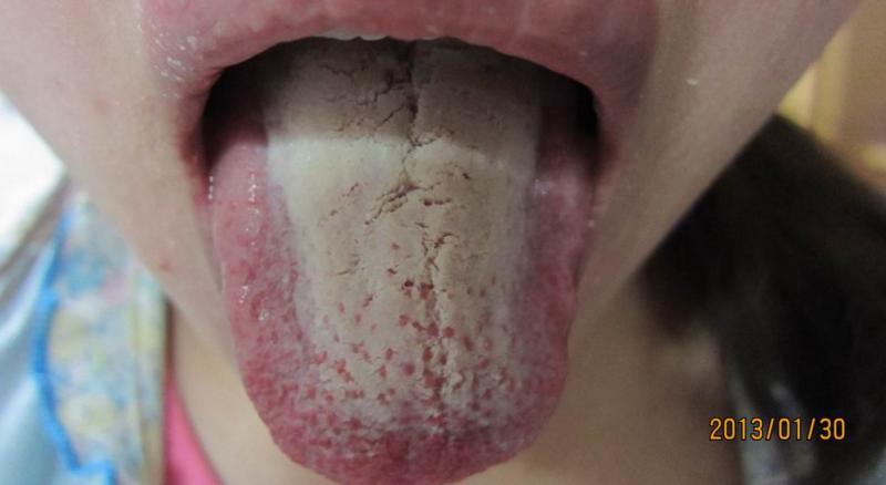 早上舌苔厚腻口气重怎么回事,早上舌苔黄腻口臭怎么办