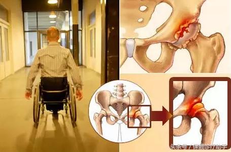 没有髋臼如何进行股骨头置换,50岁置换全髋股骨头用哪种材料好